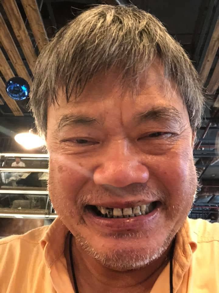 Sam smiling with a chipped front tooth in his original acrylic dentures
