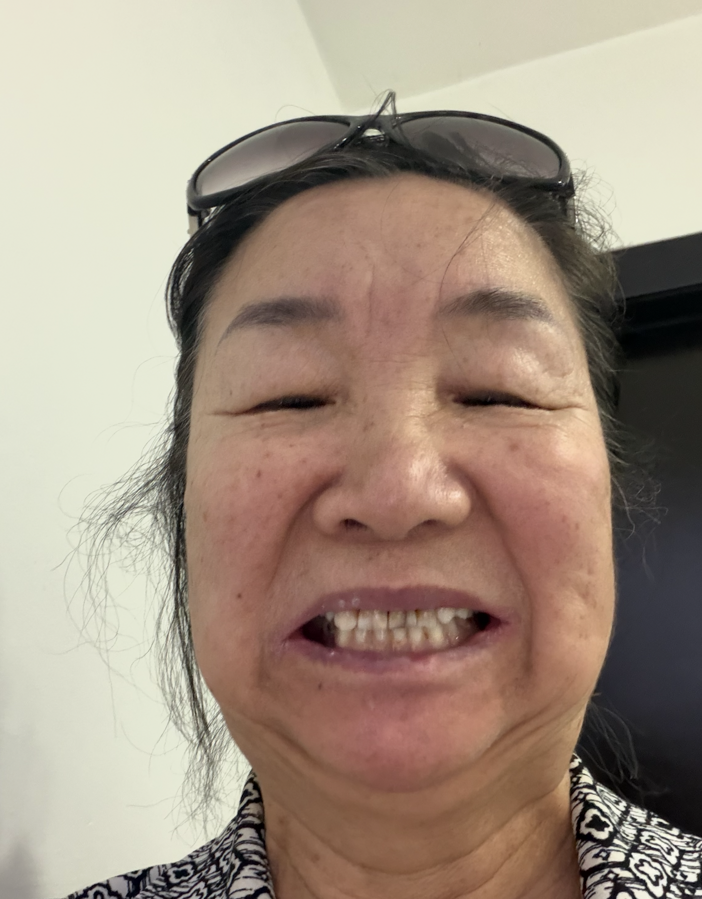 Marilyn's teeth before her dental restoration in Mexico.