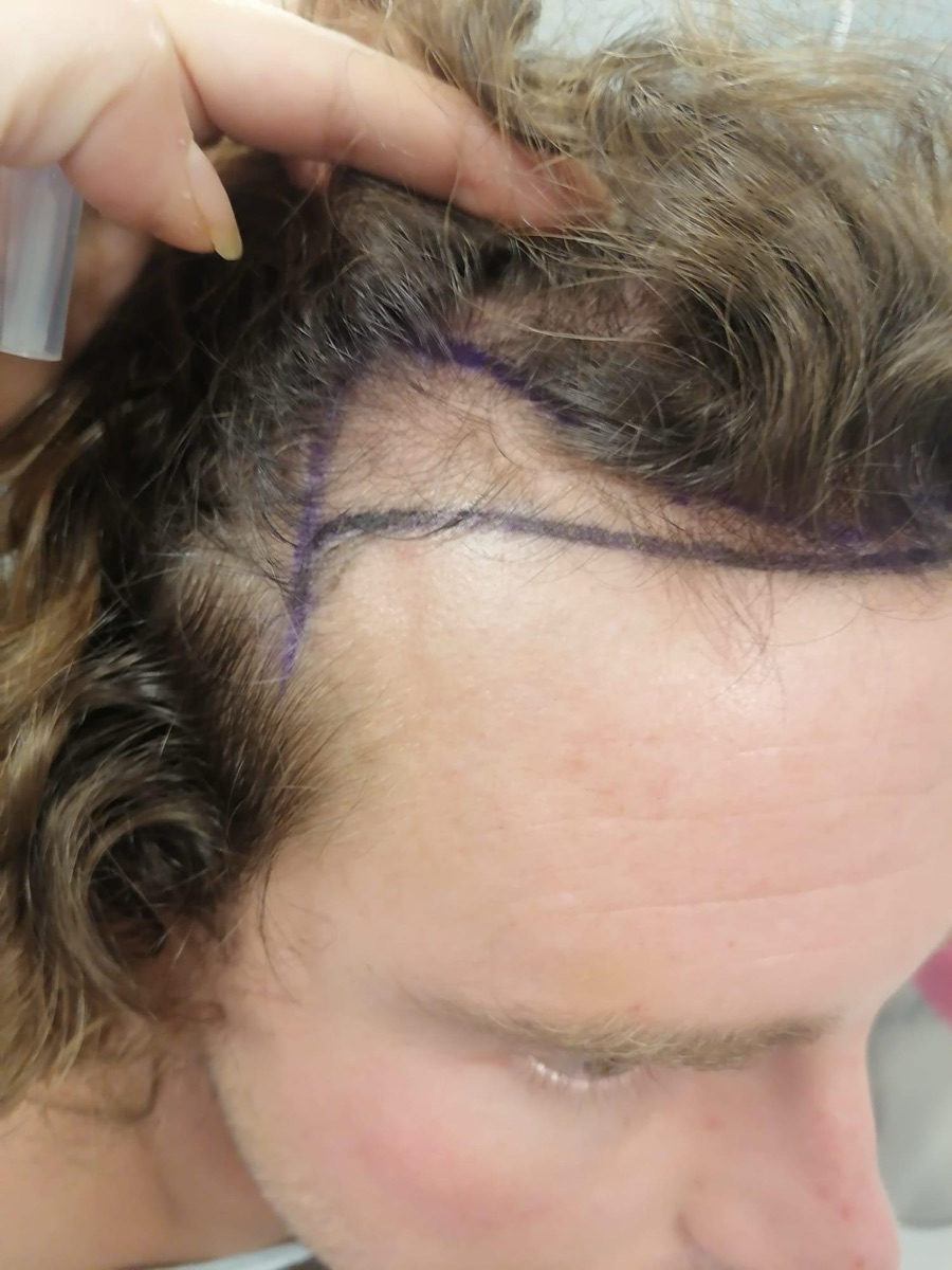 George's new hairline drawn in marker before the procedure