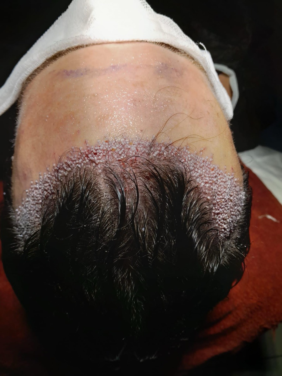George's scalp right after the transplant