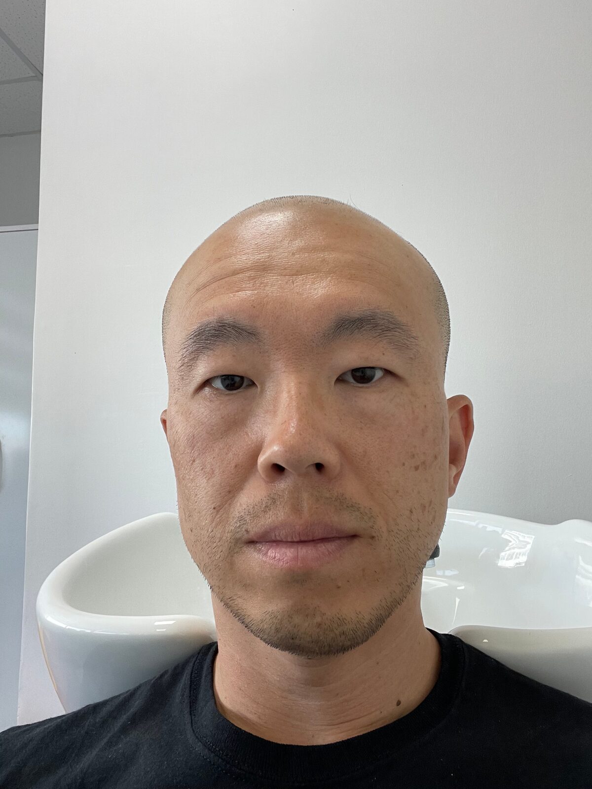 Joe with a freshly shaved head just before starting the procedure